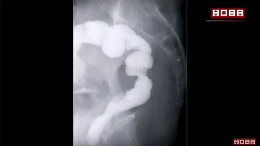colon-vagina