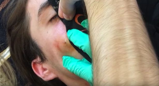 Woman-removes-enormous-cyst-from-boyfriends-face