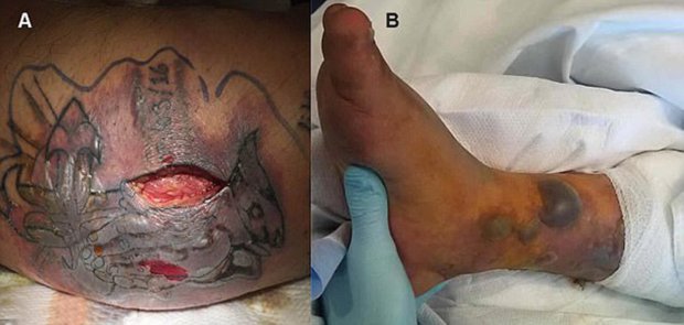 (Picture: BMJ Case Reports) Why you really shouldn't go swimming with a new tattoo: Man ignores advice to wait for 2 weeks and DIES after catching a flesh-eating bug and developing sepsis
