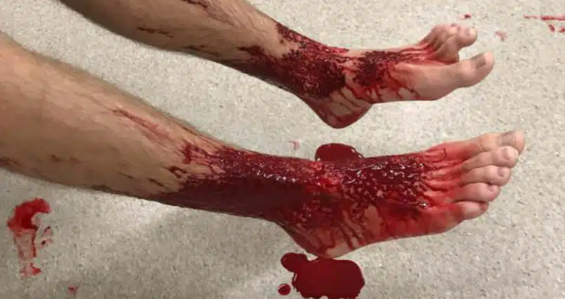 sam-kanizay-injury
