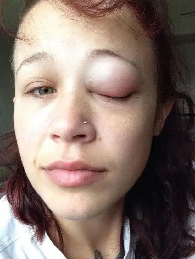 Purple eyeball
