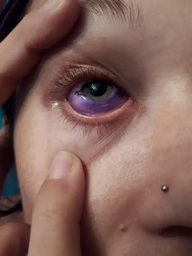 Purple eyeball