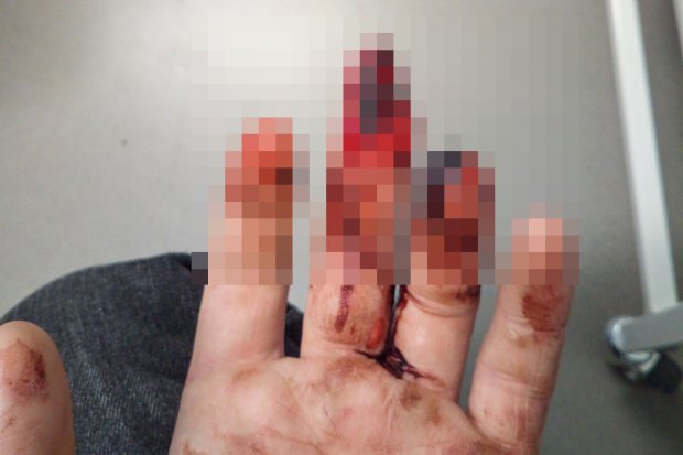 MAN LOSES FINGERTIP ON NIGHT OUT