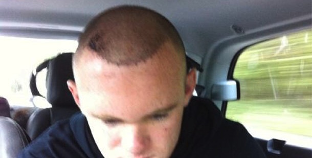 Wayne Rooney Hair Transplant