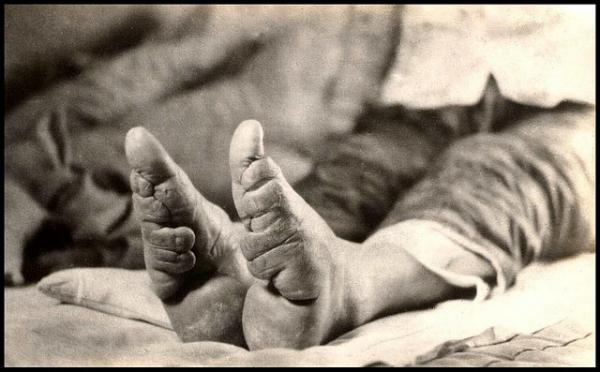 Chinese Foot Binding - Close Up