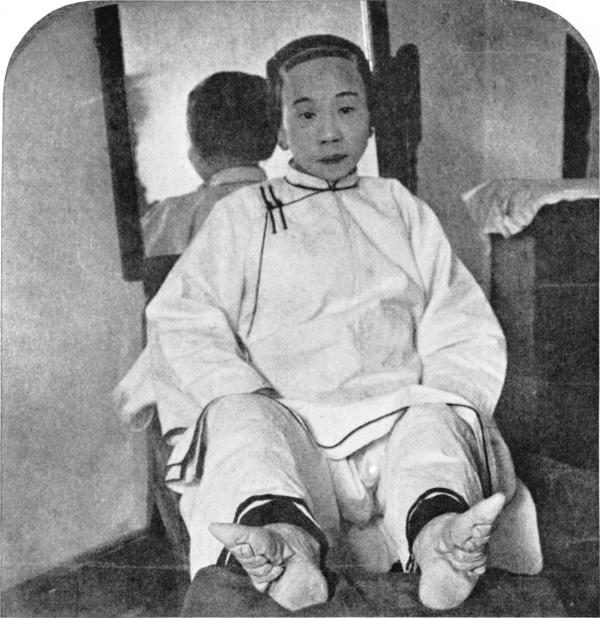 Chinese Foot Binding - Naked feet squished