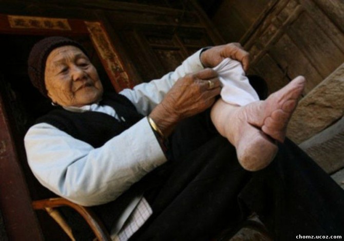 Chinese Foot Binding - Toes Almost Fused