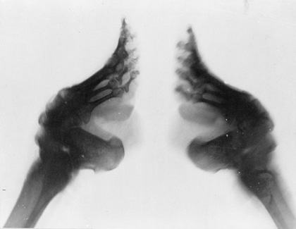 Chinese Foot Binding - X-Ray