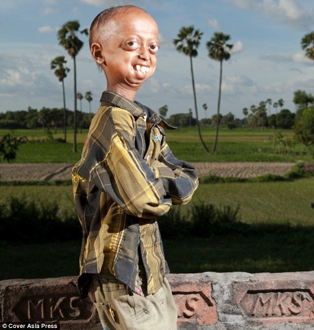 Progeria 1