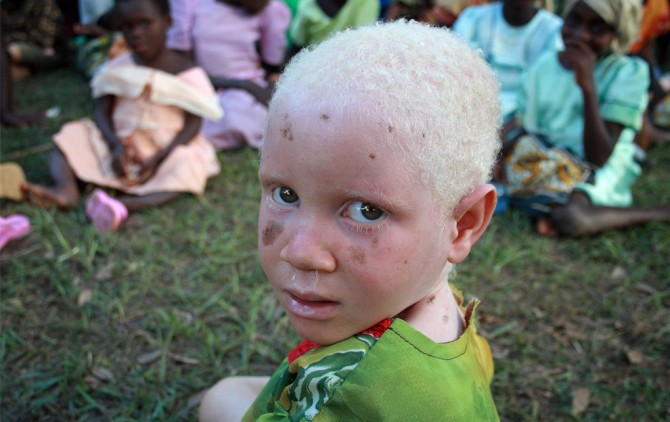 Albino child