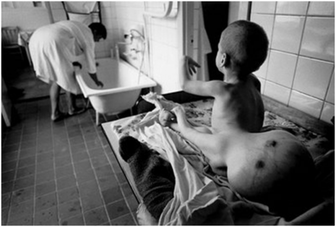 Chernobyl Nuclear Disaster - Russia - Fall Out - Effected Child