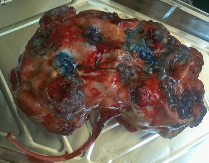 diseased lung cake
