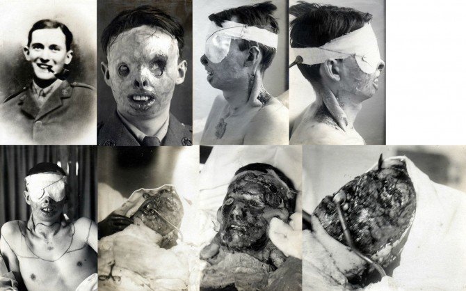 First Plastic Surgery - Harold Gillies - Henry Ralph Lumley