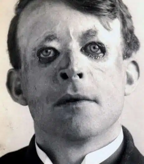First Plastic Surgery - Harold Gillies - Walter Yeo 2