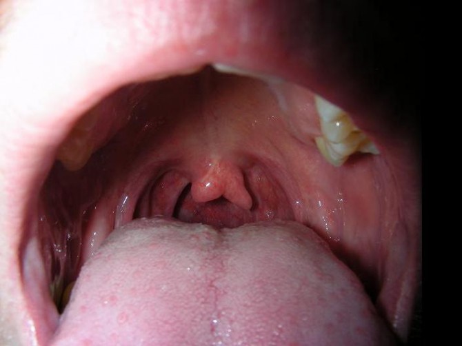 Longest Weirdest - Uvula Bifurcated