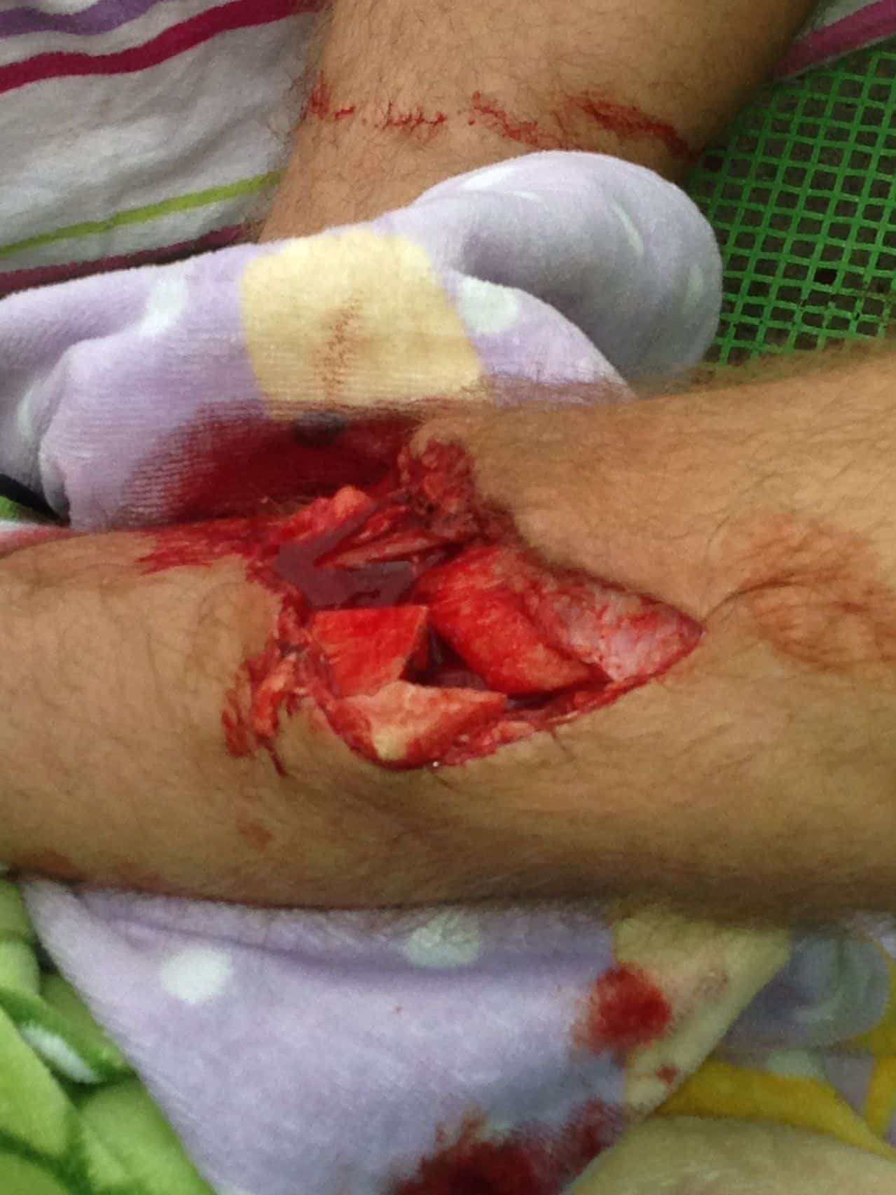 horrific trampoline injury