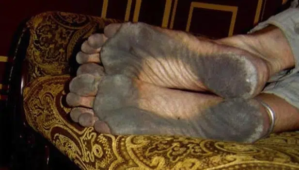 PHOTOS: Man Who Hasn’t Worn Shoes For Eight Years