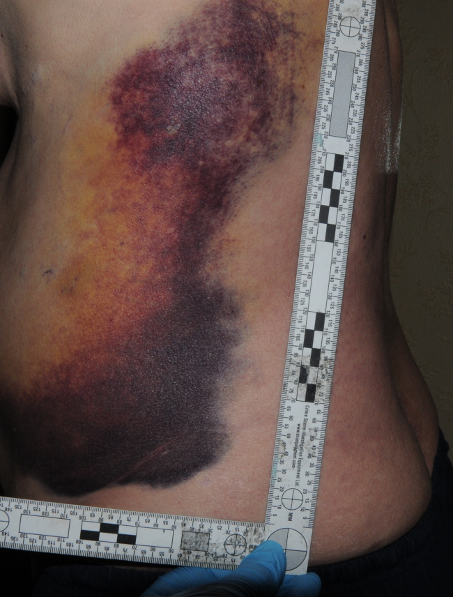 assault-injury-pic-2