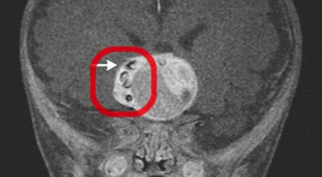 Tumour Teeth Brain