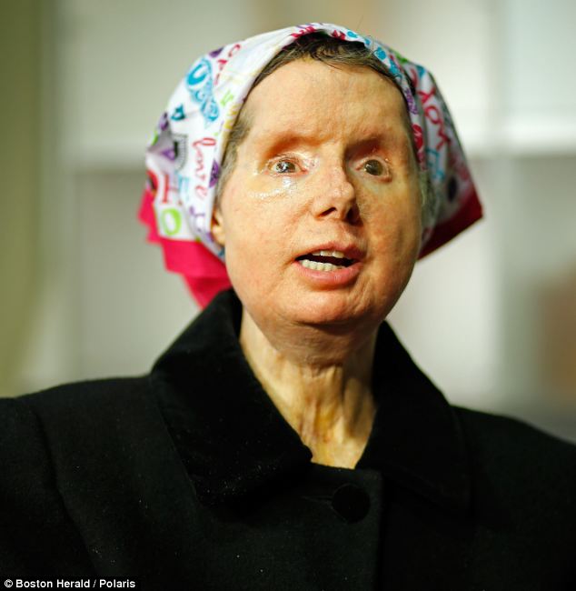 Charla Nash Facial Reconstruction 1
