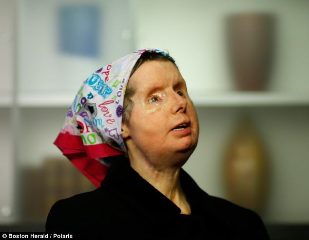 Charla Nash Facial Reconstruction 2