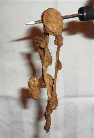 Colonic Irrigation - Bowels gross