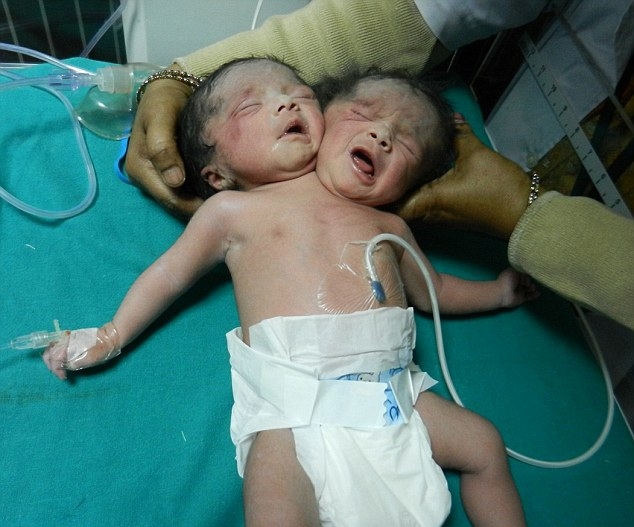 Weird News - hikha Malik two heads baby India