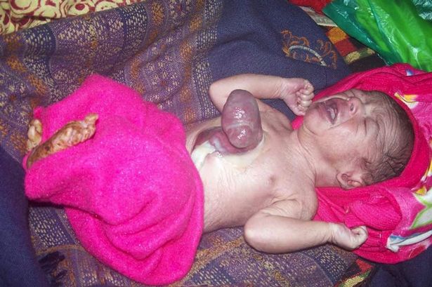Baby Heart Outside Body India - ectopia cordis 3