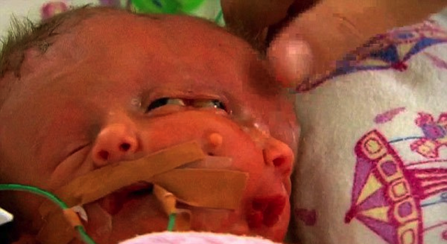 Baby Born With Two Faces