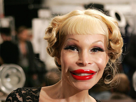 Plastic Surgery Gone Wrong 12