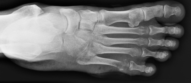 Sasamat Lake - Canadian foot xray 2