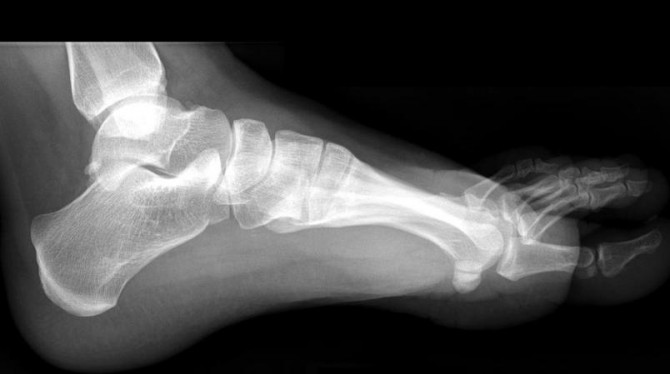 Sasamat Lake - Canadian foot xray