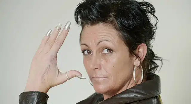 Woman Has Finger Amputated After Spider Bite