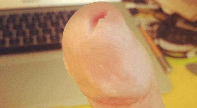 Cut Thumb Penis