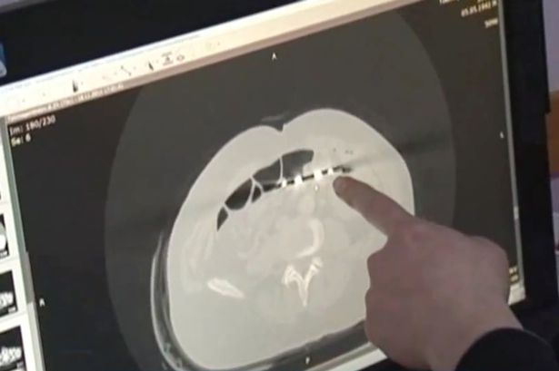 X-Ray Scissors Inside Patient 3