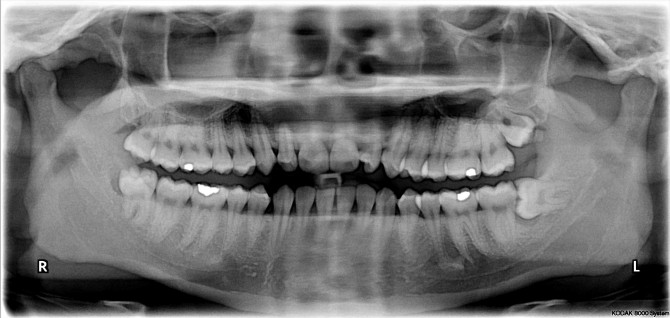 Evolution in Man - Wisdom Teeth