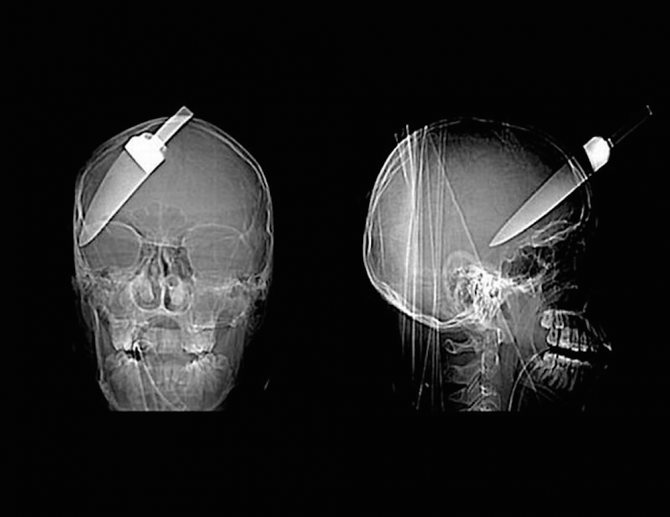 Knife In The Head X Ray