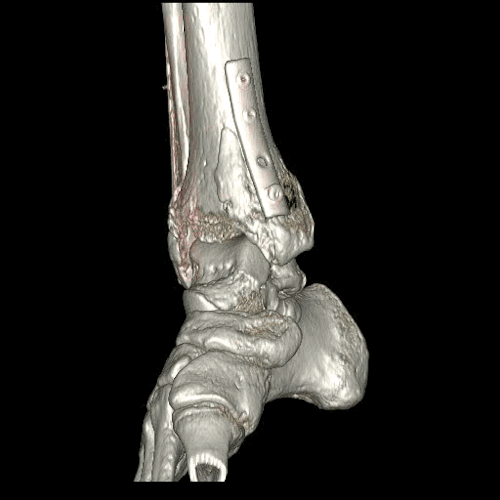 Revolution CT - Ankle With Plates And Screws