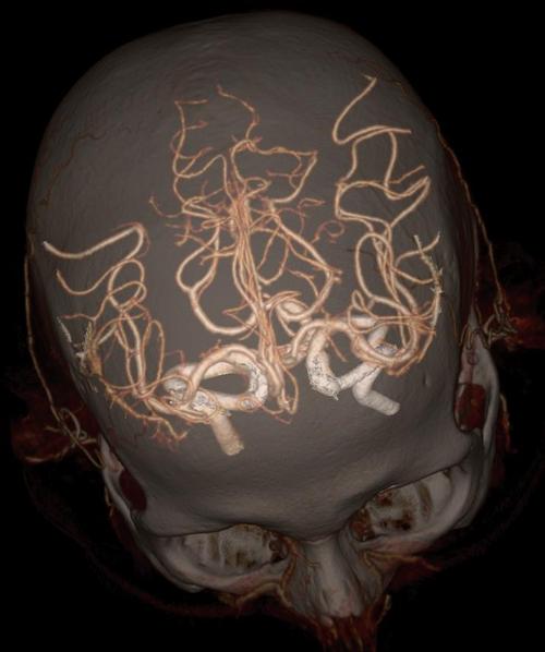 Revolution CT - Circle of Willis