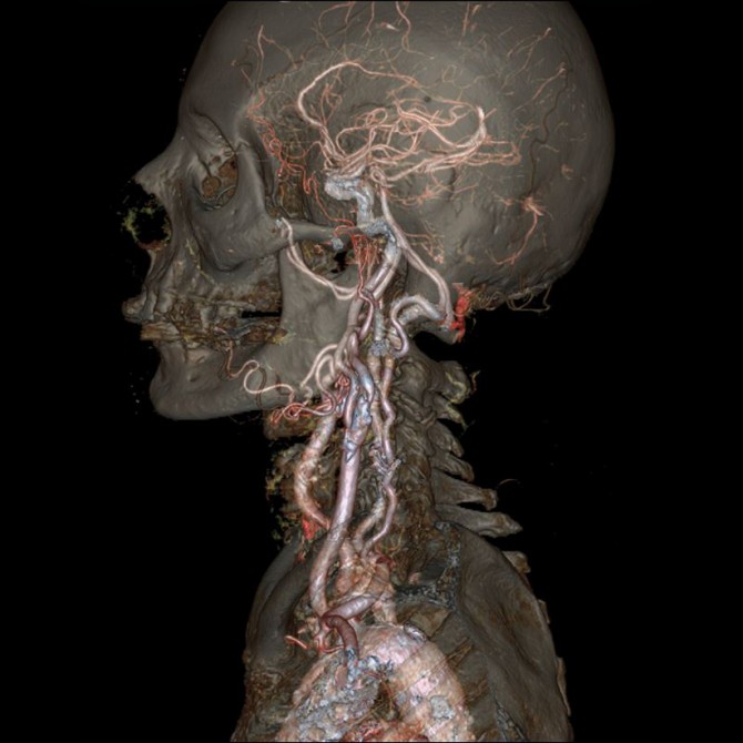 Revolution CT - Head and neck