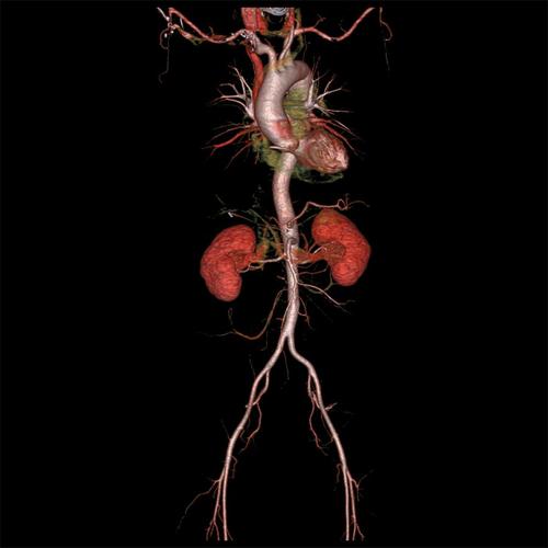 Revolution CT - Pelvis and aorta 2