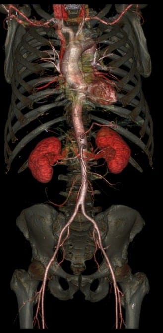 Revolution CT - Pelvis and aorta