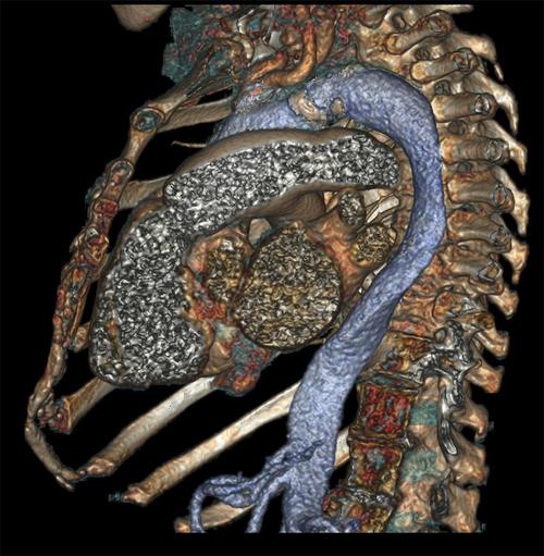 Revolution CT - Sagittal view of chest cavity and heart