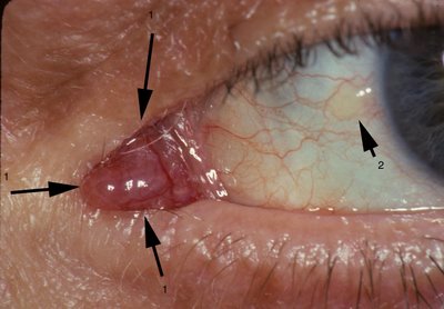 Weird Words - Lacrimal caruncle