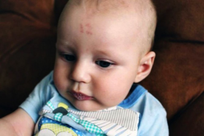 Baby 12 Birthmark
