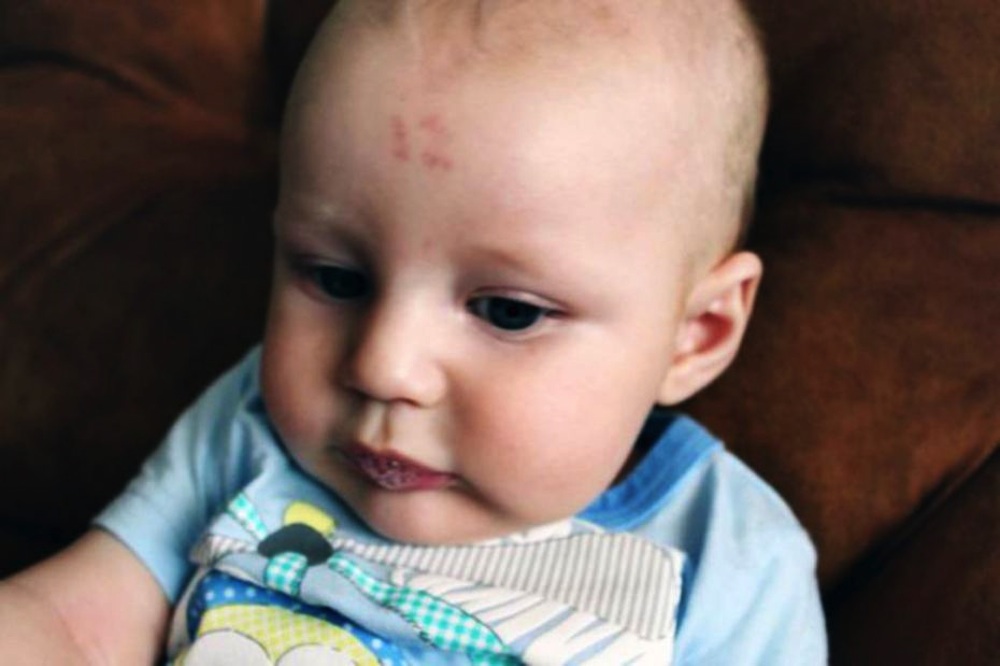 Baby 12 Birthmark