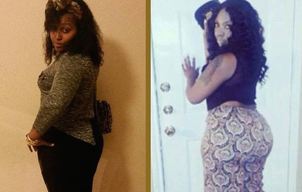 Woman Dies Black Market Butt Injections