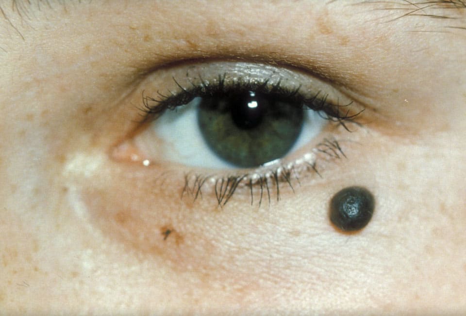 eye mole