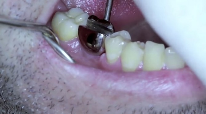 Bottle Opener In Teeth