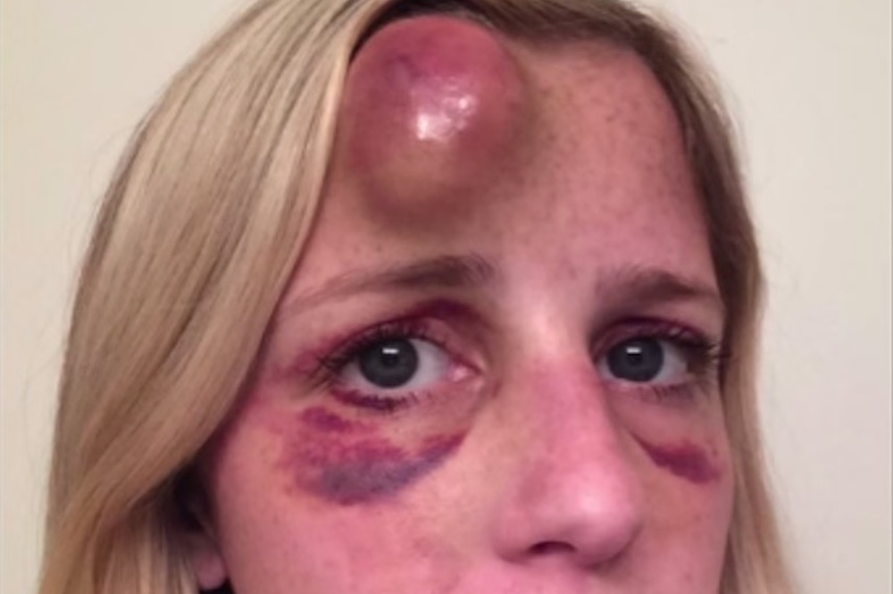 Girl With Massive Egg On Forehead